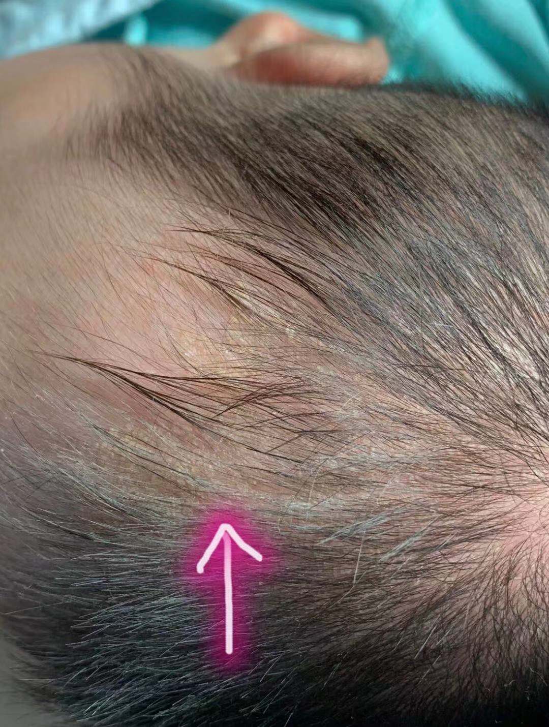 三个月婴儿头垢图片