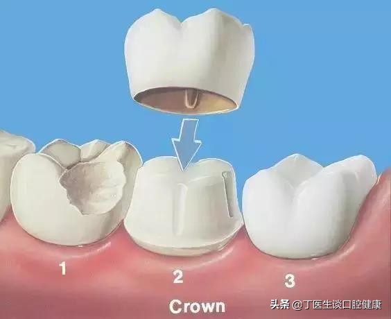 完全不懂，补牙材料这么多，到底怎么选？