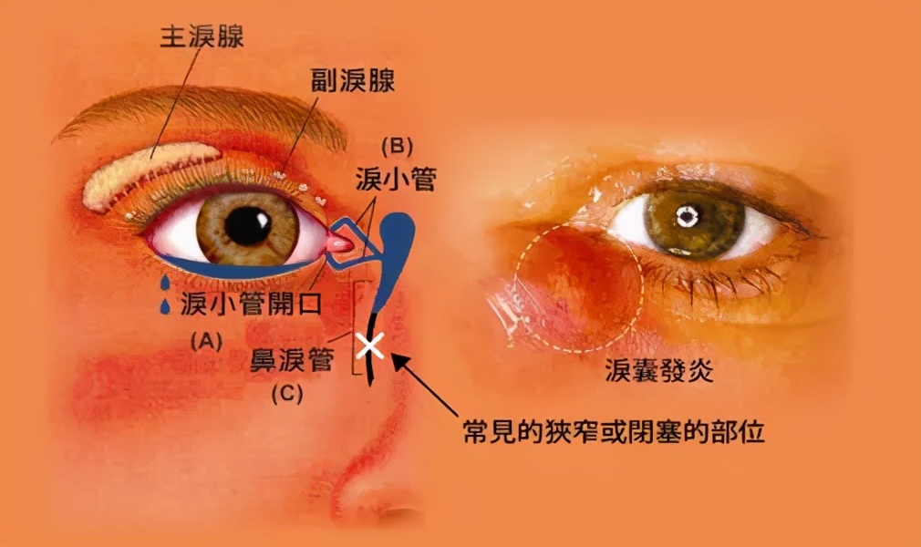 眼角炎症怎样治疗图片