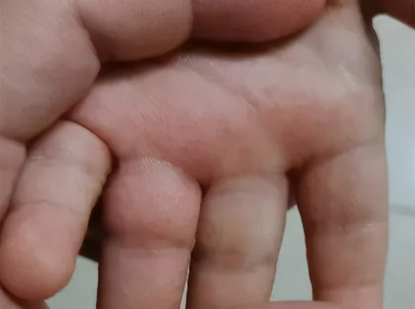 孩子手上起很痒的小疙瘩，是什么？怎么办？