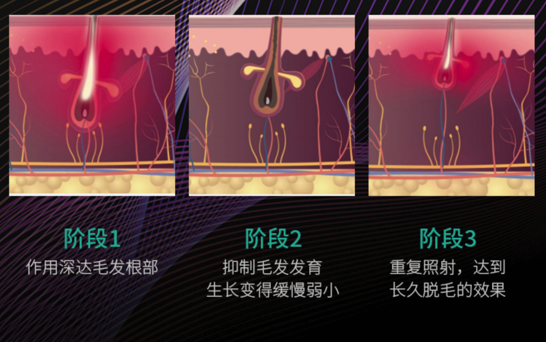 脱毛之计在于夏，三款主流脱毛仪横评：Ulike 、 歌岚、 慕金