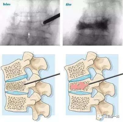 脊柱压缩性骨折如何治疗？脊椎骨折后打钢钉还是注射骨水泥？