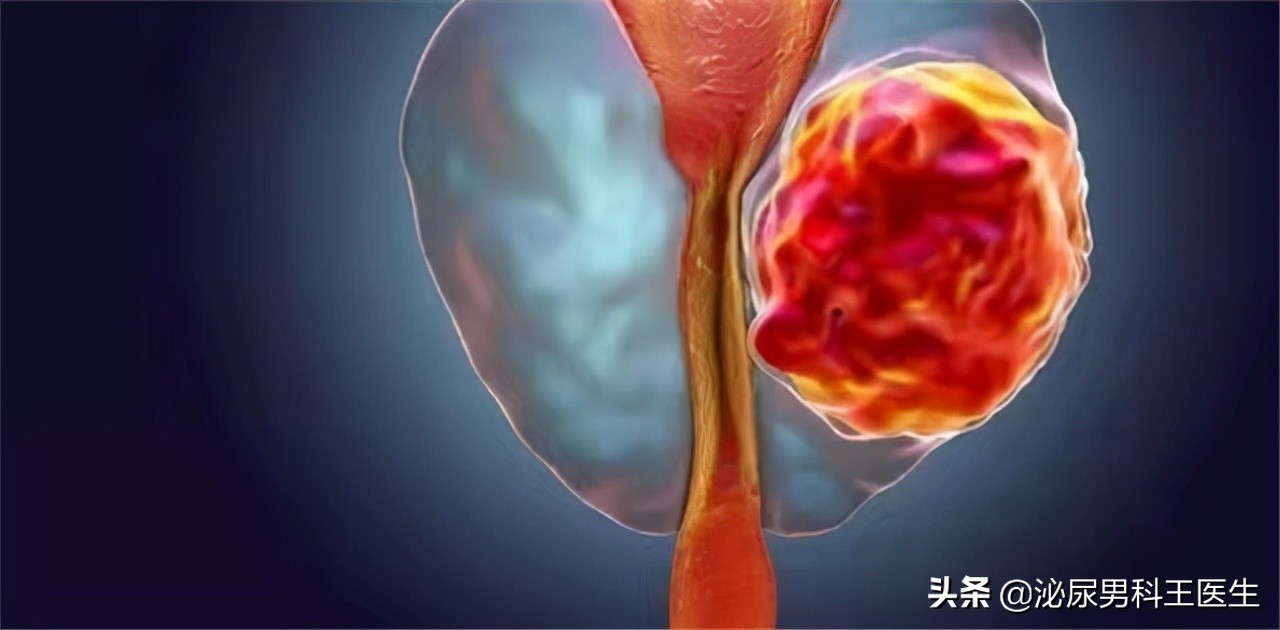 前列腺钙化治疗方案及健康影响评估