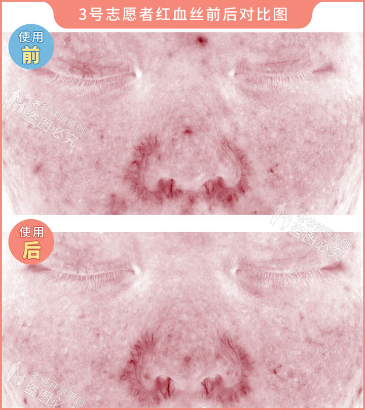 网红家用美容仪真的有效吗？2个多月的跟踪实测结果来了