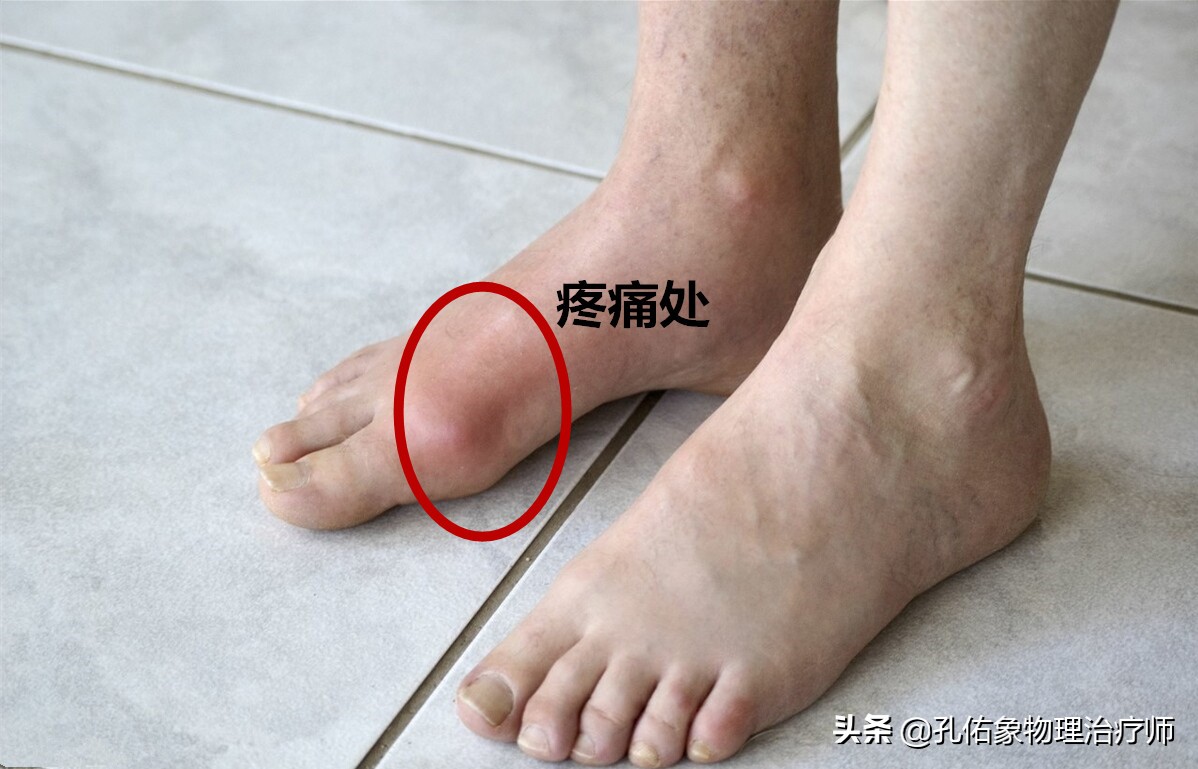 嘌呤食物一览表，尿酸高的人好好看看