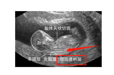 nt筛查是指胎儿颈部透明带厚度及孕妇血清检验.