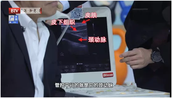 颈动脉斑块能逆转?满足3个条件,常吃“3+3+2”,调血脂、控斑块,血管更健康