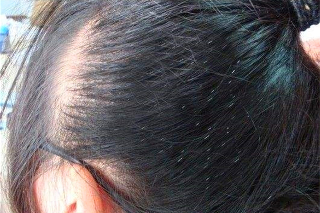 头发虱子图片(同人类共进化) - 赤虎壹号