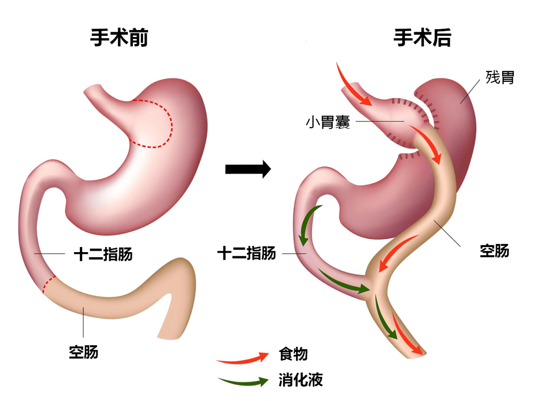 袖状胃空肠旷置手术图片