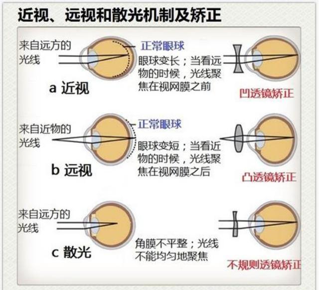 练跳水会近视吗(陶勇：青少年防治近视，这八大误区一定要先清楚)