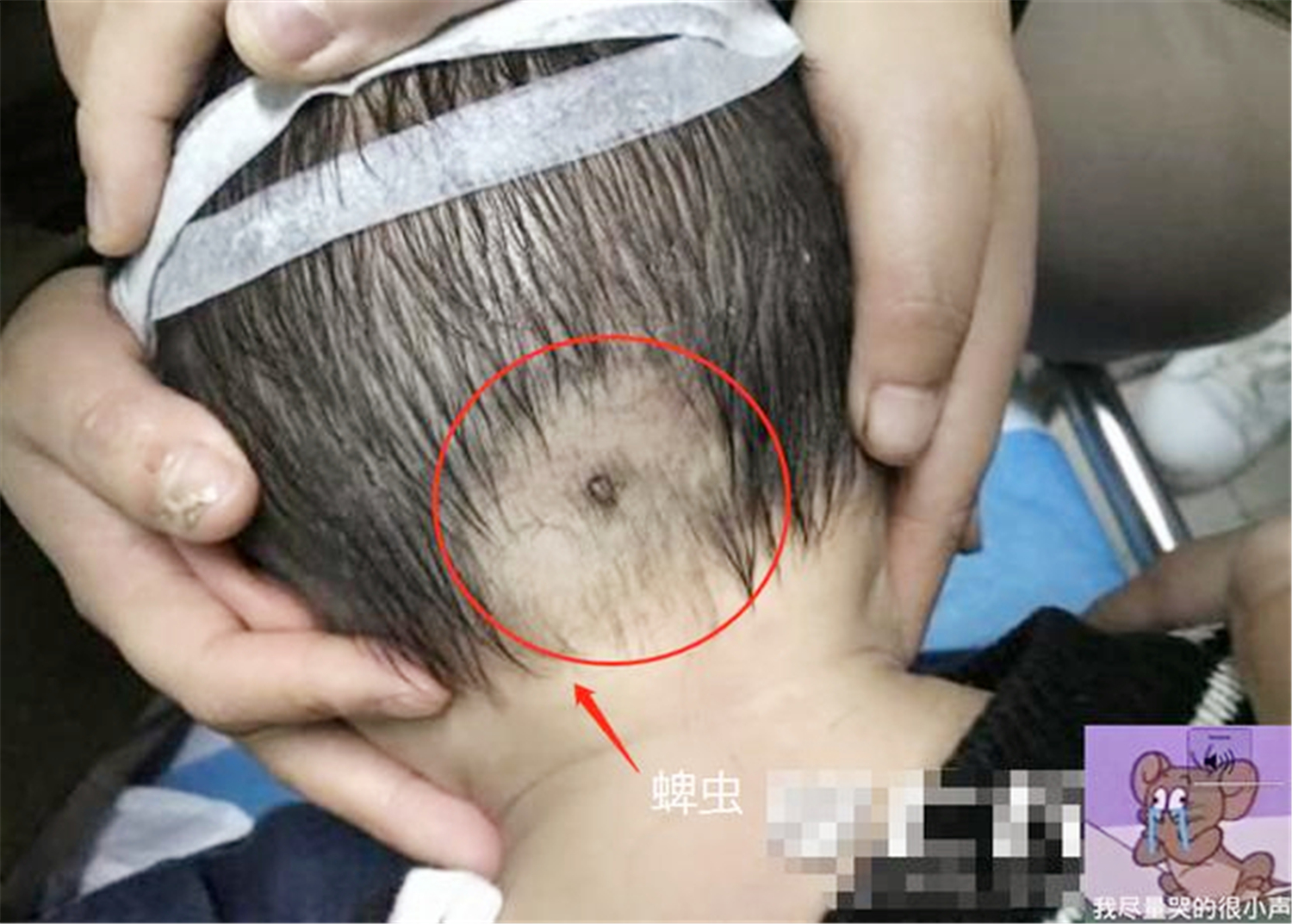 "蜱虫"钻进4岁男童后脑勺,家长注意4件事,别心大不知道