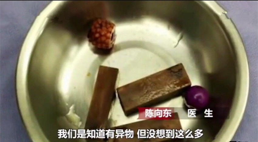 女童私处发出恶臭，经手术竟在下体取出这么多异物，父母们别大意