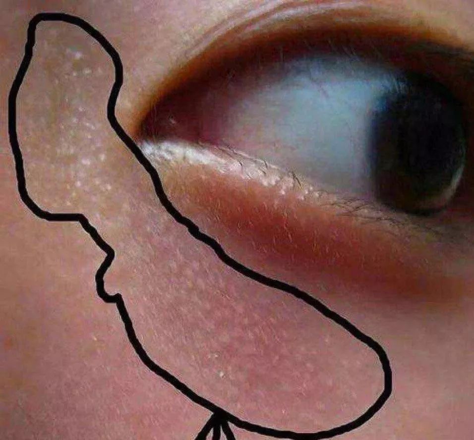 栗丘疹怎么去除小妙招 治疗粟丘疹的最佳方法 - 汽车时代网