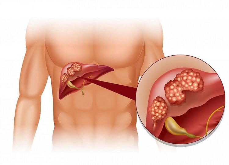 肝功能检查报告，主要看哪几项指标？3个数值“透露”肝脏状态