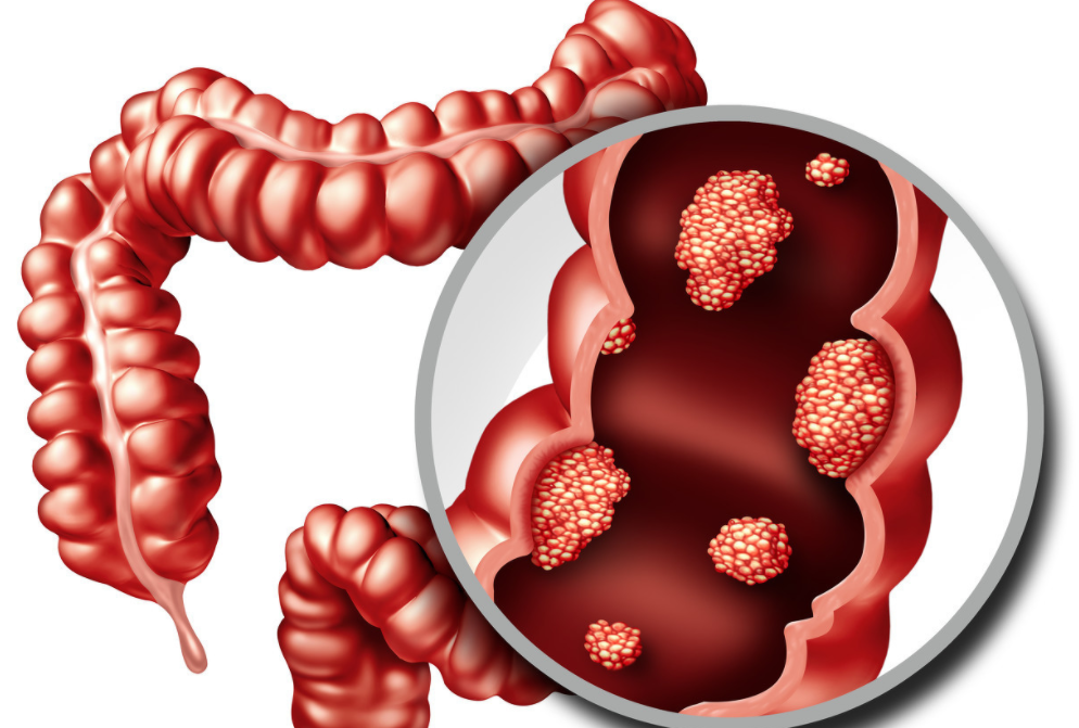 肠癌早期症状 肠病的早期10个征兆-乐百科