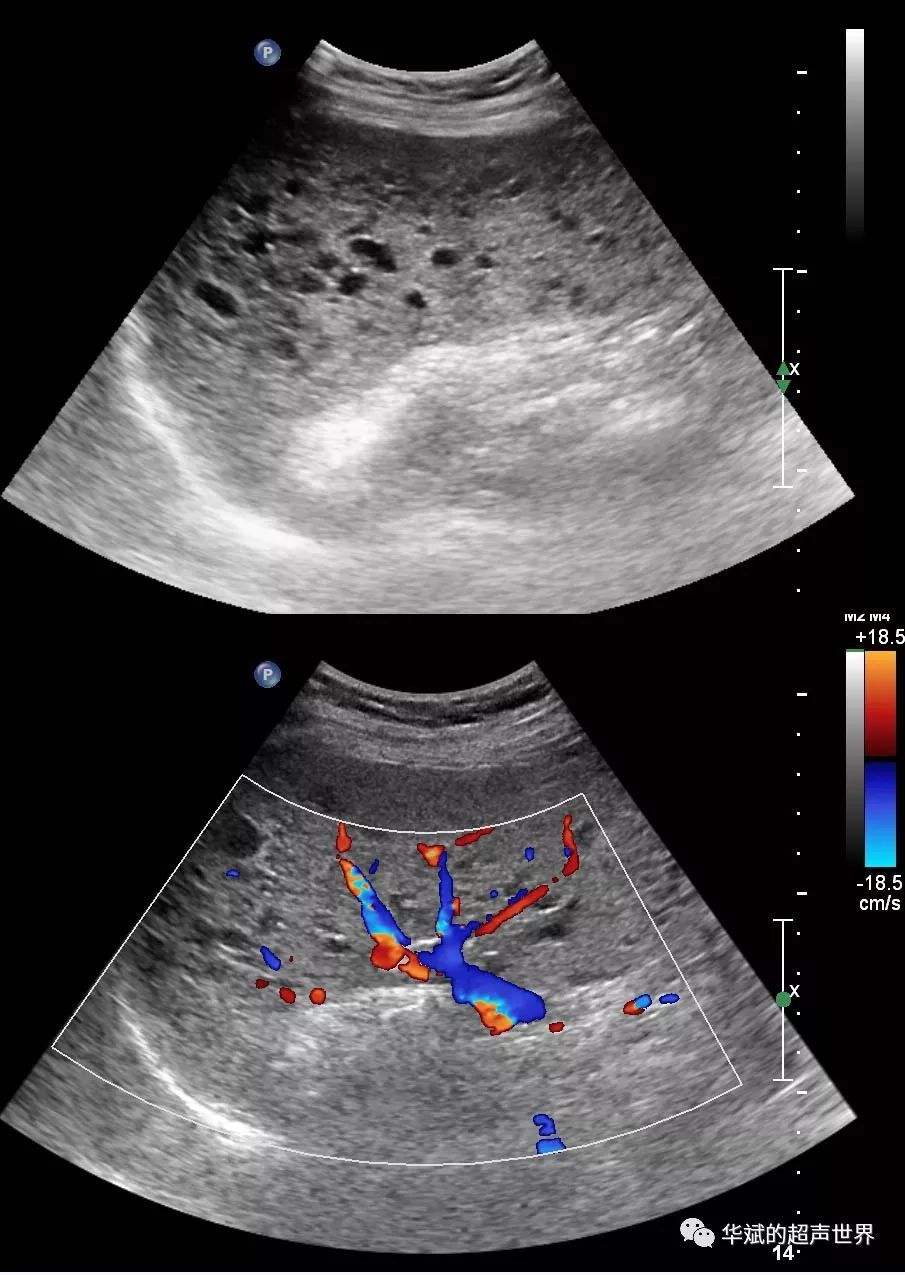 脾大能自己恢复吗?