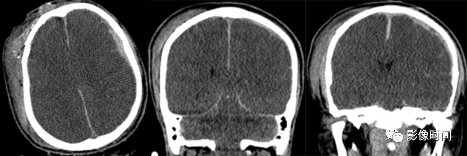 颅脑外伤的急诊 CT 表现