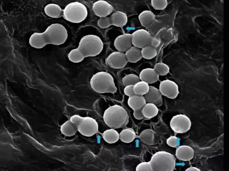 夏天腋下,肩背部长褐色或白色的斑疹,不痛不痒,可能是汗斑