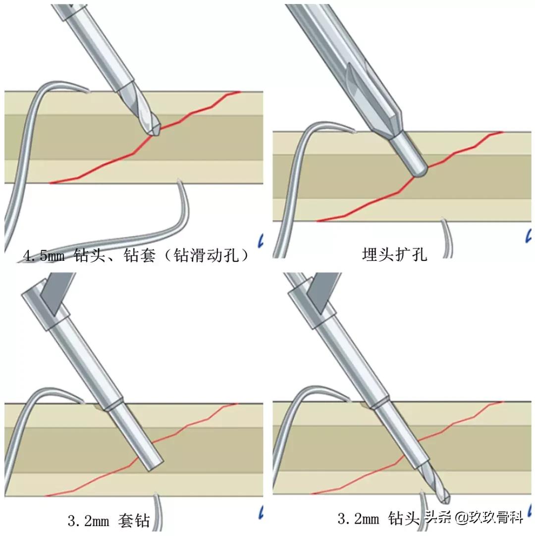 拉力螺钉使用的小技巧