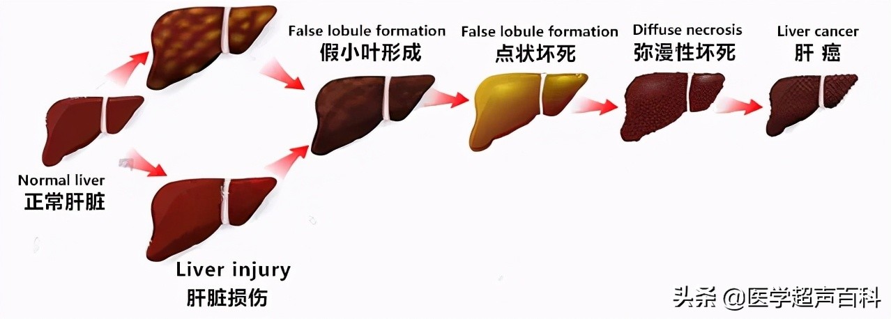 b超报告中超声号是什么意思(超声检查中，肝脏B超报告单常见术语全在这里，都有必要了解)