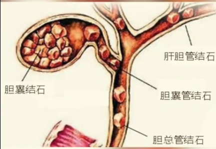 女子手术取出7750颗胆结石！看看你平时有没有这样的坏习惯