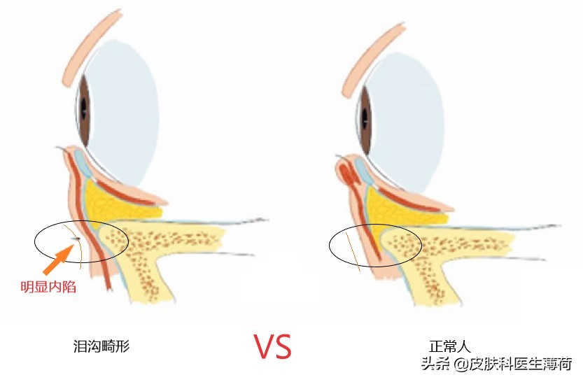 黑眼圈怎么形成的？如何彻底的去黑眼圈？|皮肤科医生良心出品