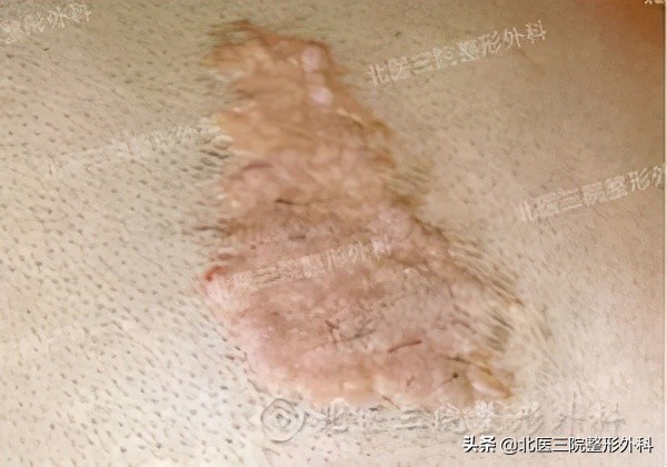 聊一聊：你熟悉的“痦子”