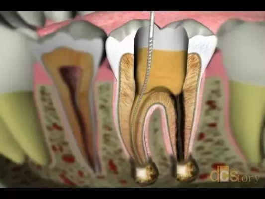 牙疼后为什么医生建议你根管治疗而不是补牙