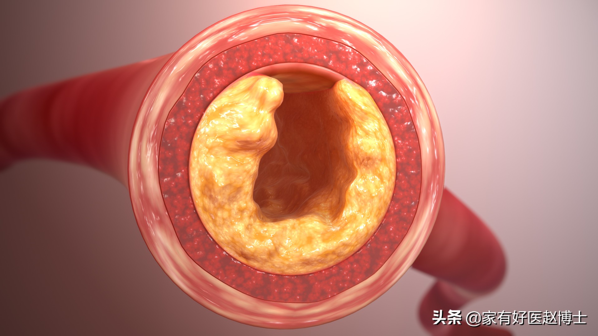 脂蛋白a升高，究竟提示何种风险？“无药可治”，应该如何破解？