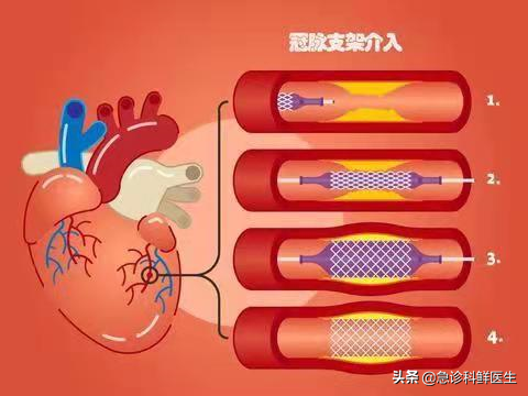 心脏支架手术，到底是治病救人，还是缺德害人？医生告诉你真相