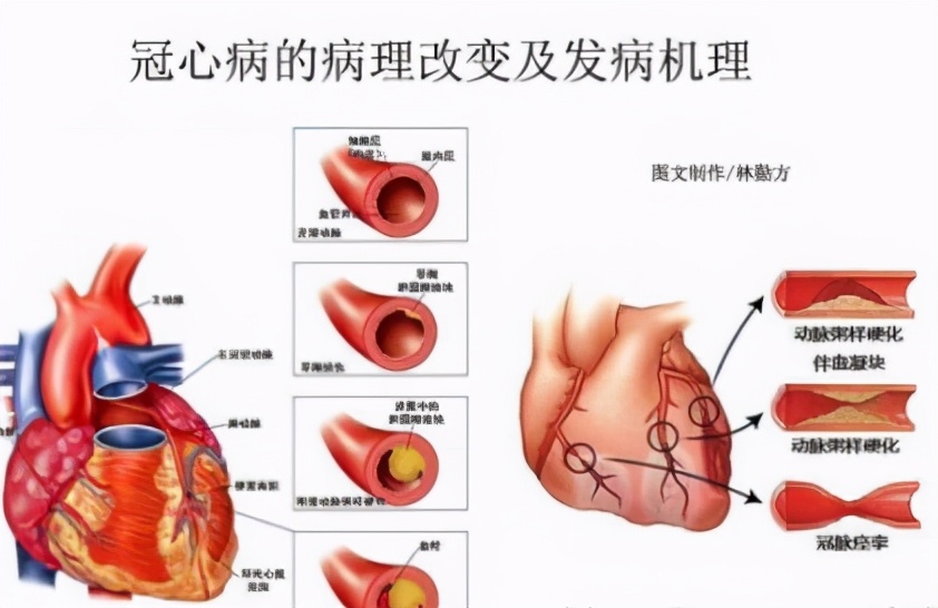 冠心病最爱找这几种人的麻烦，如果出现这5大现象，一定及时就医
