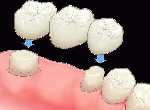 种植牙齿哪里最好(种植牙和烤瓷牙：你更适合哪个？牙科医生告诉你两者的利与弊)