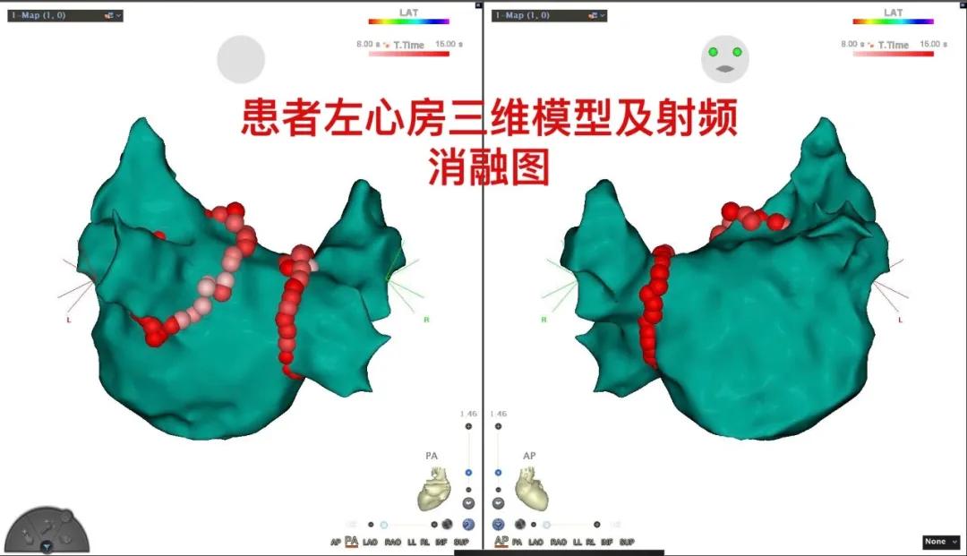 射频消融术让房颤患者重获“心”声