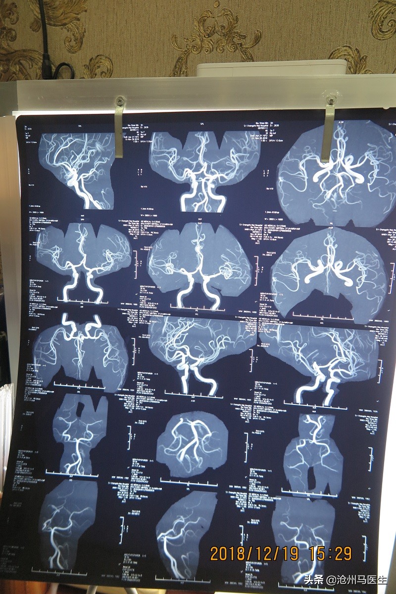 天旋地转，眩晕恶心、呕吐、心慌的中医治疗病例报告分析