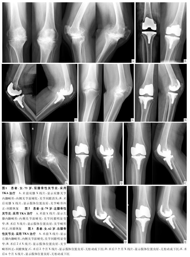 全膝关节置换术怎么样？医生：跟着我一起来学习一下吧