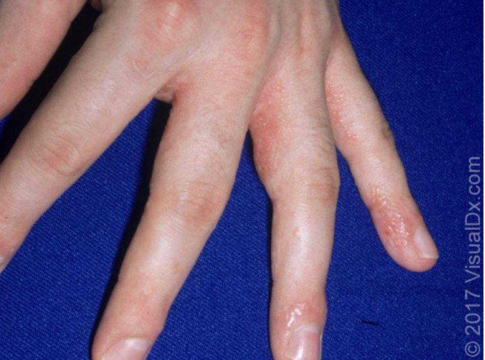 「汗疱疹」如何根治？与湿疹、手足癣的关系？都解答在这里了