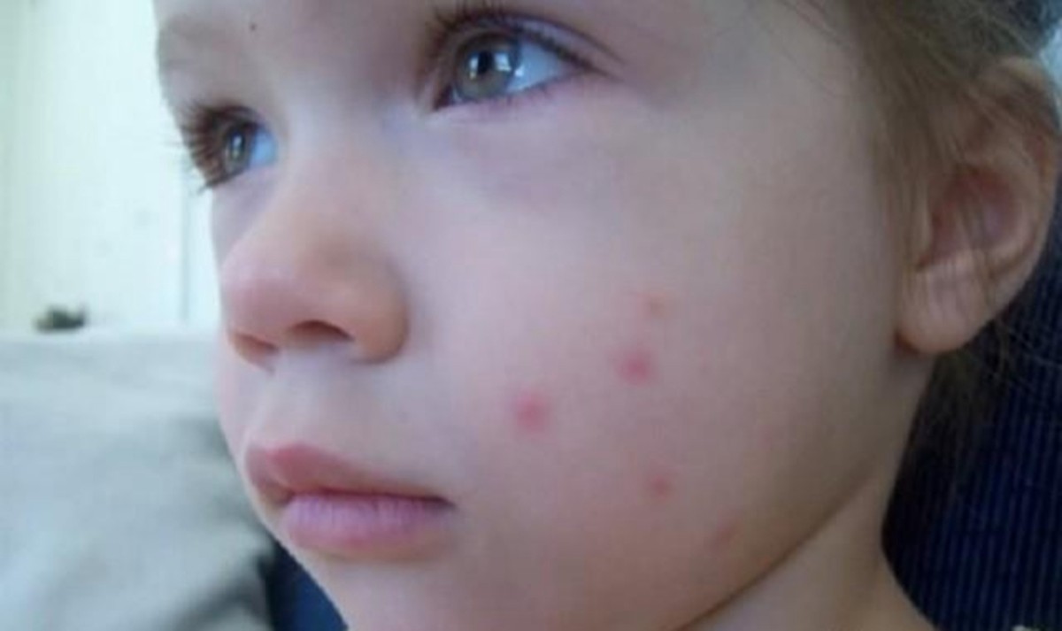 宝宝被蚊子叮咬可能会存在哪些"潜在危害"?每个家长都该看看