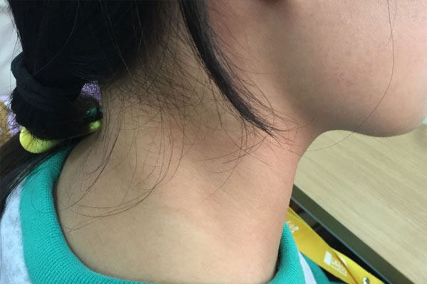 淋巴结肿大又是怎么回事?两者是一回事吗?