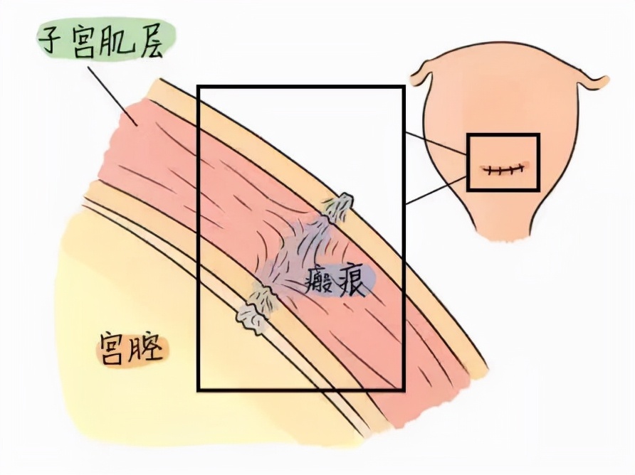 有喜却不是好孕，有一种危险叫子宫瘢痕妊娠！教你三招远离它