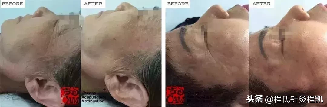 别在脸上乱动刀子了!这个风靡日本的美容秘技助你重回颜值巅峰