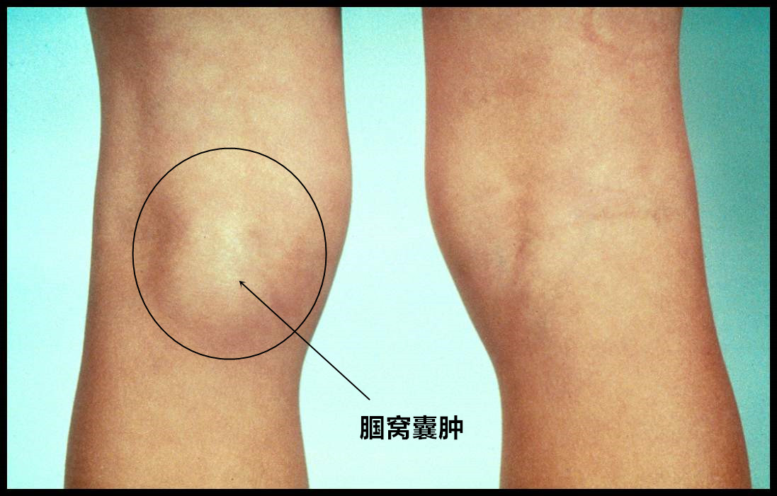 会在报告上看到一句话"腘窝内囊肿,用手一摸,膝盖窝里还真有一个鼓包