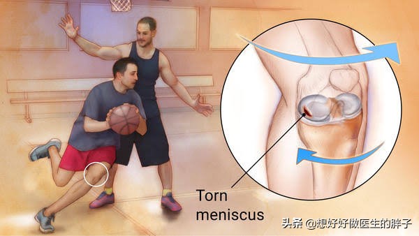 打篮球为什么会损伤半月板(篮球运动中常见的运动损伤有哪些？如何预防和治疗？医生告诉您)