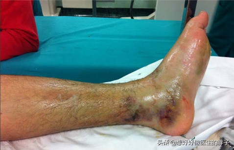 小腿胫腓骨骨折后，医生不急于手术，为什么？术前要注意些什么呢