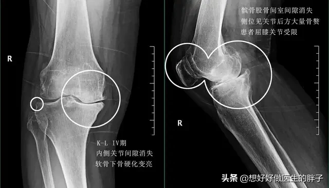 髌骨软骨磨损了，很多朋友会上下楼梯疼、弹响，这毛病能治好吗