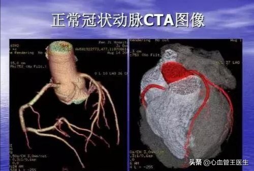 心脏造影比心脏CT好？辟谣：都有辐射，选择适合患者的才是好医生