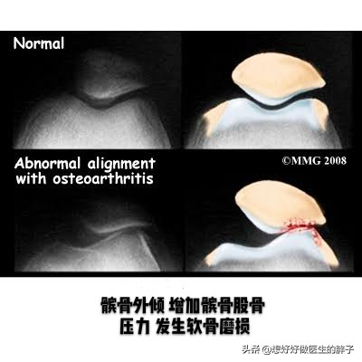 髌骨软骨磨损了，很多朋友会上下楼梯疼、弹响，这毛病能治好吗