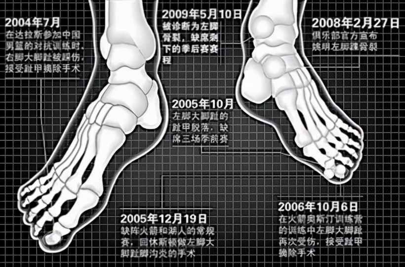 nba脚趾为什么那么多(看了詹姆斯脚趾、马龙白发、罗斯膝盖，你还羡慕NBA球星高薪吗？)