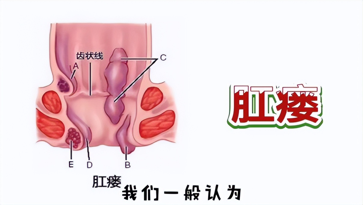 肛瘘手术疼吗 怎么判断自己得了肛瘘-百联百科