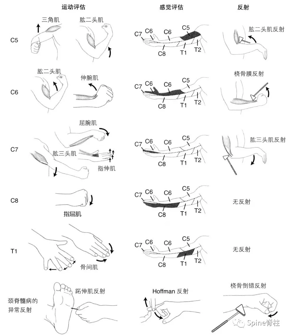 颈椎病：定义、分型、临床表现、治疗和预防