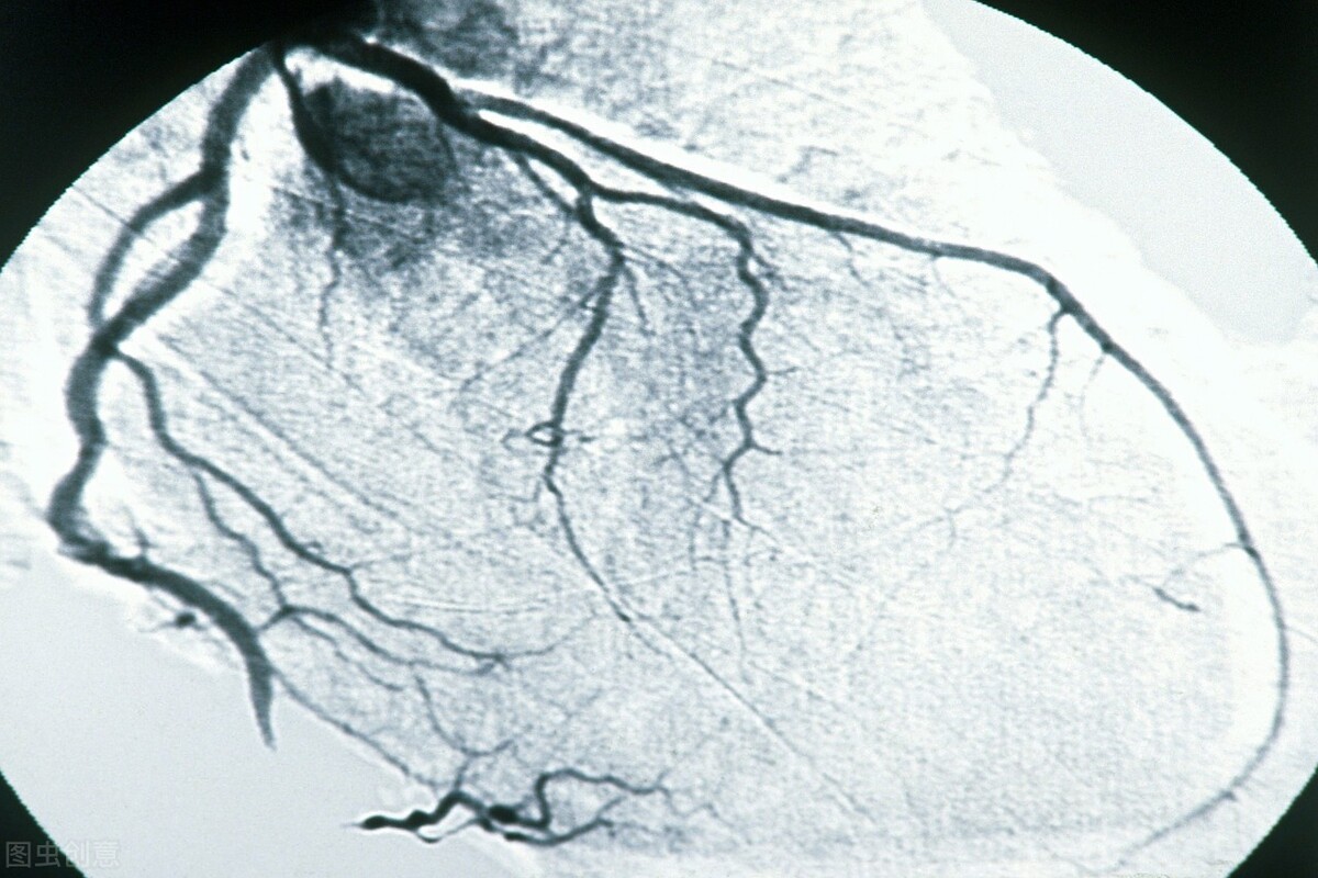 做冠脉造影后人活不久了吗？带来的这4个风险，要了解清楚